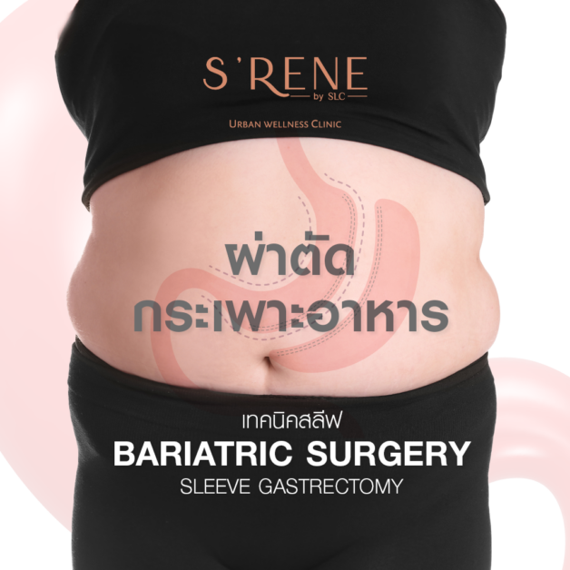 โปรแกรม ผ่าตัดกระเพาะ เทคนิคสลีฟ | Bariatric Surgery (Sleeve Gastrectomy)
